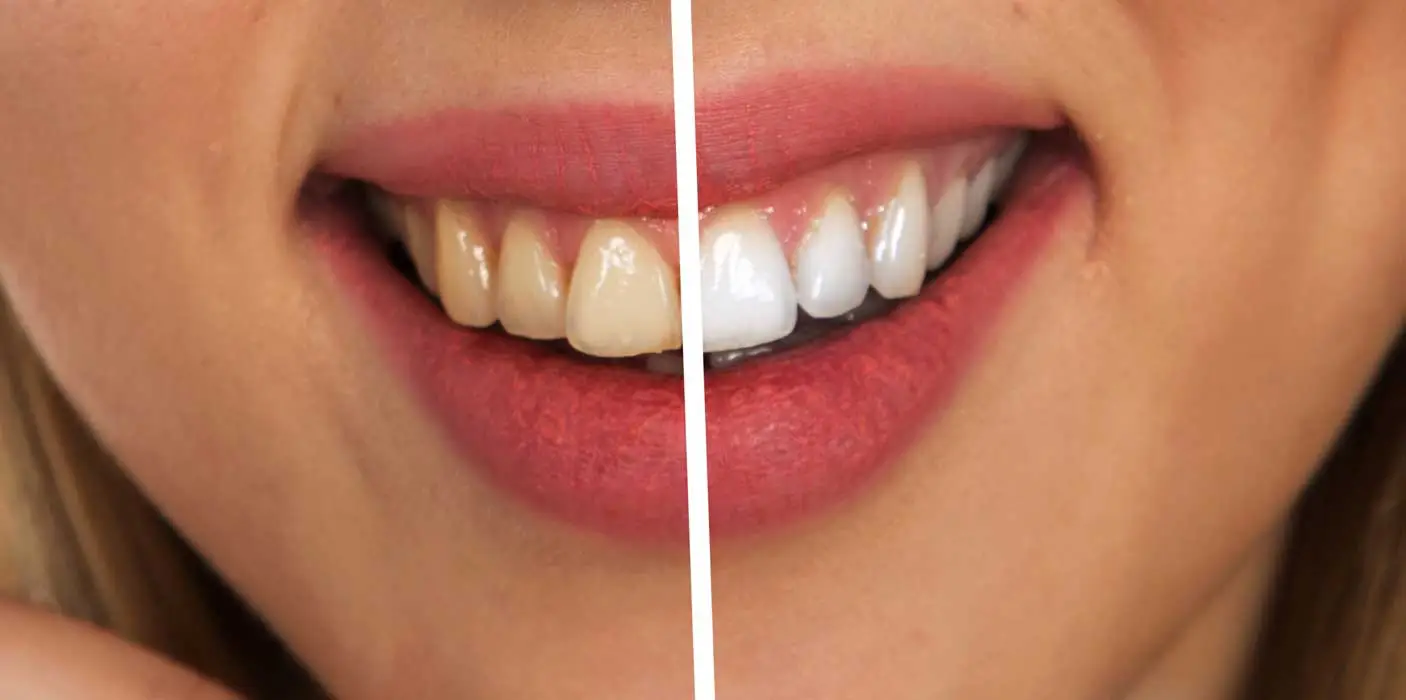 Teeth Whitening in Kenya