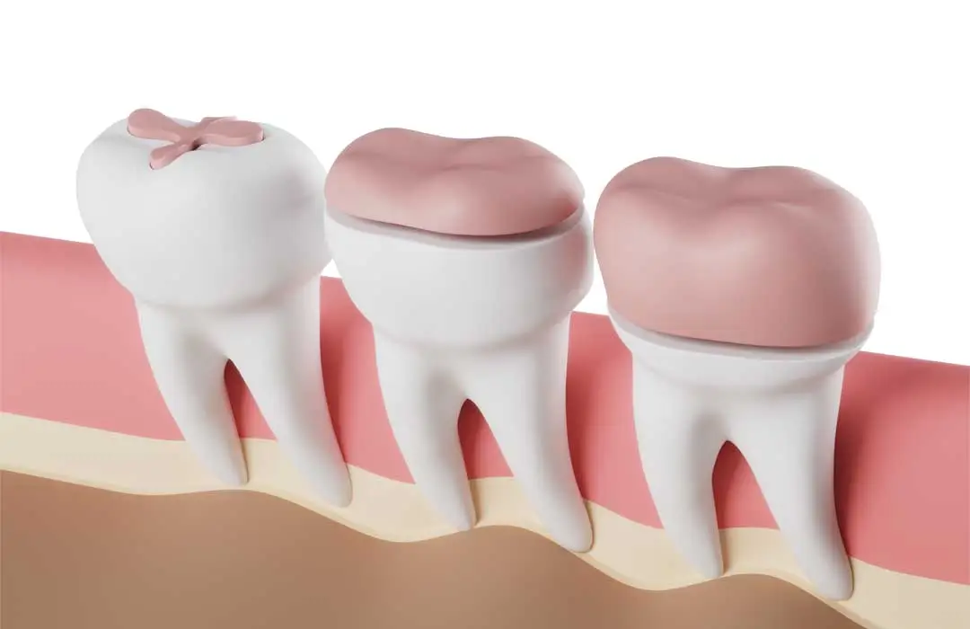 Tooth fillings in Kenya