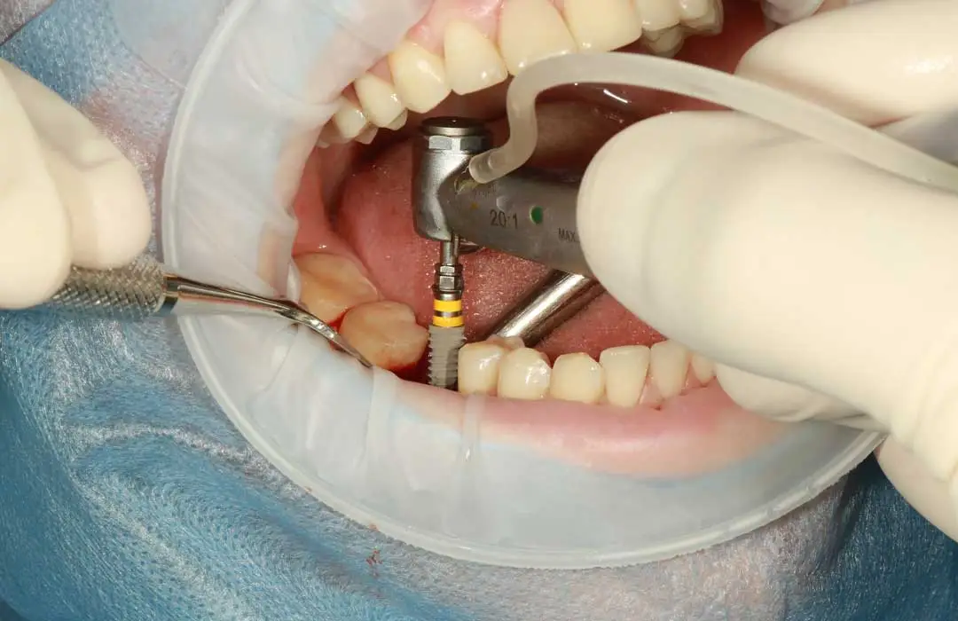 Dental Implants in Kenya